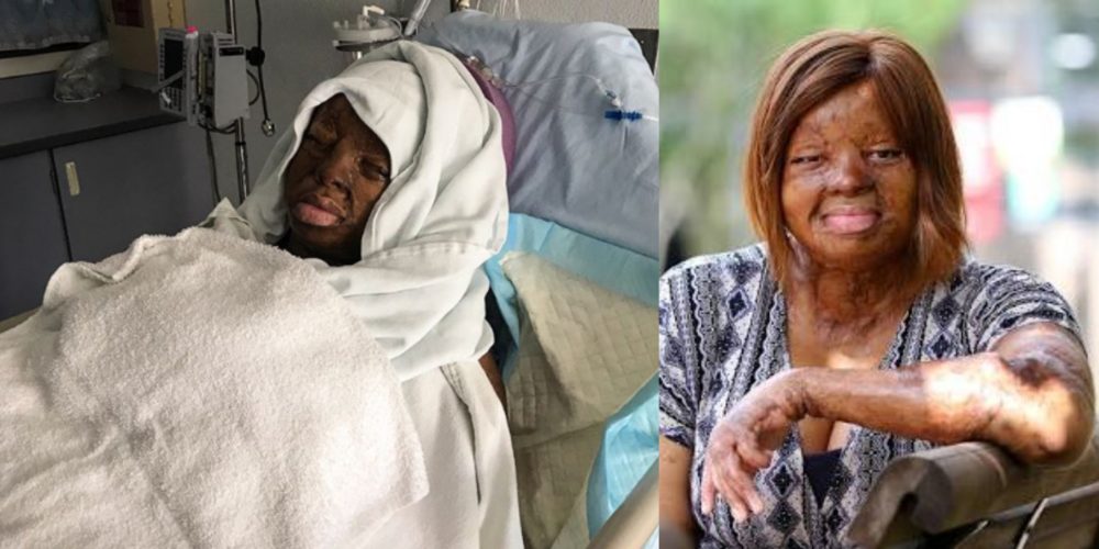 Sosoliso plane crash survivor, Kechi Okwuchi undergoes another surgery